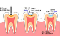 歯医者は苦手だけど、痛いのはイヤ……そんな方に3mix法