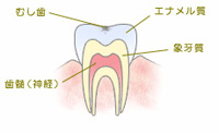 虫歯