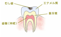 虫歯