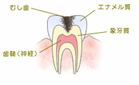 虫歯