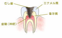 虫歯